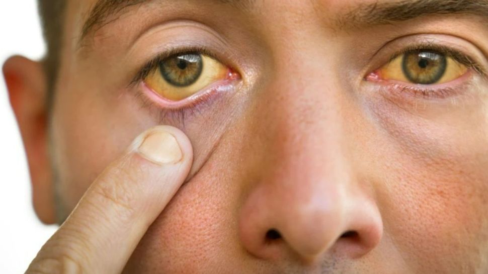 High Cholesterol Level Eyes Can Detect These Three Warning Signs Of Bad ...