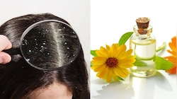 Dandruff Remedies: മുടിയിൽ എണ്ണ തേക്കുന്നത് താരൻ വർദ്ധിപ്പിക്കുമോ? 