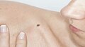 Lucky Moles: ശരീരത്തിന്റെ ഈ ഭാഗത്ത് മറുകുള്ള പെൺകുട്ടികൾ ഭാഗ്യവതികൾ!