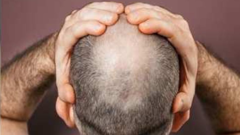Hair Transplant Death Hair Transplant Leads To Death In A Youth From
