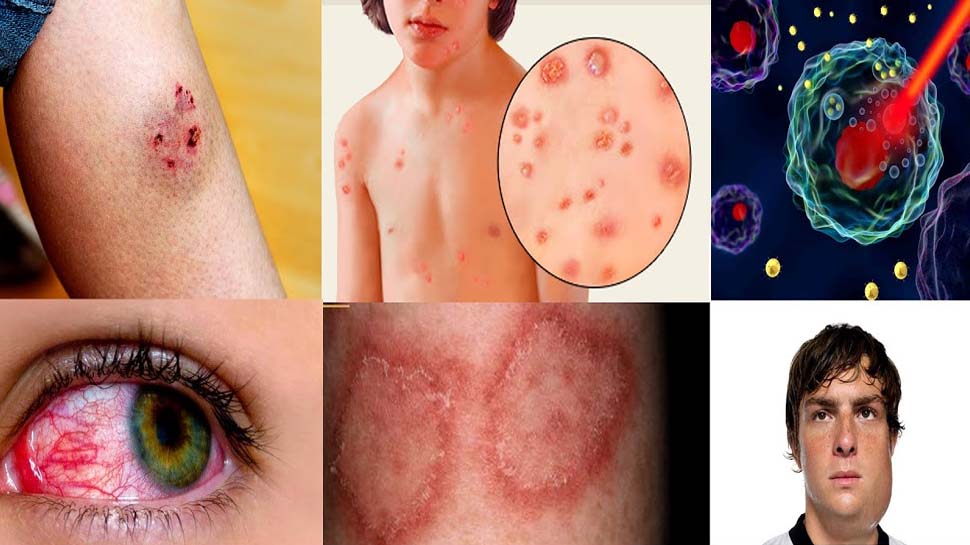 Common Summer Season Diseases what are the symptoms and how to prevent
