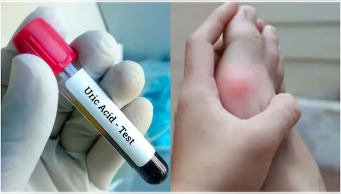 Uric acid: യൂറിക് ആസിഡിന്റെ അളവ് കൂടിയാൽ പ്രശ്നമാണോ? ഈ തെറ്റുകൾ ആവർത്തിക്കരുത്!