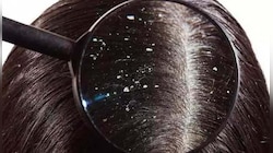 Dandruff Home Remedies: ആര്യവേപ്പ്, ഉലുവ, തൈര്; ഈ പൊടിക്കൈ മതി താരന്‍ പറപറക്കും 