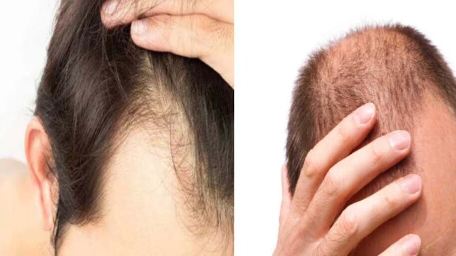 Oil for Hairfall: മുടി കൊഴിച്ചിലിനോട് പറയാം ബൈ ബൈ, ഈ എണ്ണകള്‍ പരീക്ഷിക്കൂ 