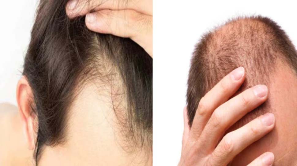 Oil for Hairfall: മുടി കൊഴിച്ചിലിനോട് പറയാം ബൈ ബൈ, ഈ എണ്ണകള് പരീക്ഷിക്കൂ Oil for Hairfall: മുടി കൊഴിച്ചിലിനോട് പറയാം ബൈ ബൈ, ഈ എണ്ണകള് പരീക്ഷിക്കൂ
