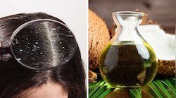 Dandruff Treatment: താരന്‍ മൂലം വിഷമിക്കുന്നോ? ഈ വീട്ടുവൈദ്യങ്ങൾ പരീക്ഷിക്കൂ