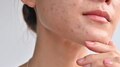 Bad cholesterol: ചർമ്മത്തിൽ ഈ മാറ്റങ്ങളുണ്ടോ? ചീത്ത കൊളസ്‌ട്രോൾ ഉണ്ടെന്ന് ഉറപ്പിക്കാം!