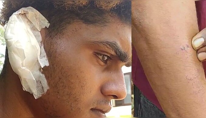 Crime News: യുവാവിനെ സാമൂഹ്യവിരുദ്ധർ അക്രമിച്ച് ചെവി കടിച്ച് പറിച്ചതായി പരാതി