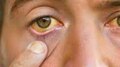 Jaundice: വേങ്ങൂരിന് പിന്നാലെ കളമശേരി നഗരസഭയിലും മഞ്ഞപ്പിത്ത ഭീതി; ഒരാഴ്ചയ്ക്കിടെ രോഗം സ്ഥിരീകരിച്ചത് 28 പേർക്ക്
