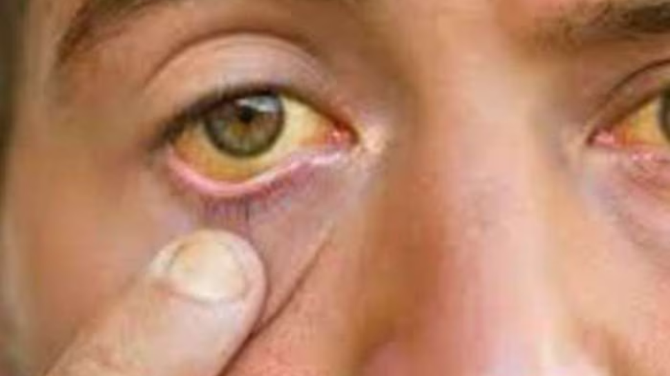 Jaundice precautions: മഞ്ഞപ്പിത്തം മുതിര്ന്നവരില് ഗുരുതരമാകാന് സാധ്യതയേറെ; ഈ കാര്യങ്ങൾ പ്രത്യേകം ശ്രദ്ധിക്കുക Jaundice precautions: മഞ്ഞപ്പിത്തം മുതിര്ന്നവരില് ഗുരുതരമാകാന് സാധ്യതയേറെ; ഈ കാര്യങ്ങൾ പ്രത്യേകം ശ്രദ്ധിക്കുക