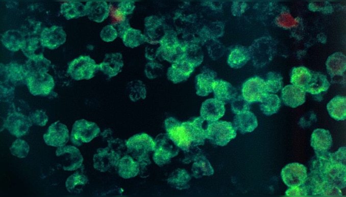 Amebic Meningoencephalitis: കോഴിക്കോട് വീണ്ടും അമീബിക് മസ്തിഷ്ക ജ്വരം; രോഗം സ്ഥിരീകരിച്ച 12കാരന്റെ ആരോഗ്യ നില ഗുരുതരം