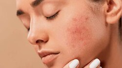 Skin Care: സ്കിൻ അലർജിക്ക് പരിഹാരം, ഇവ കഴിച്ചോളൂ!