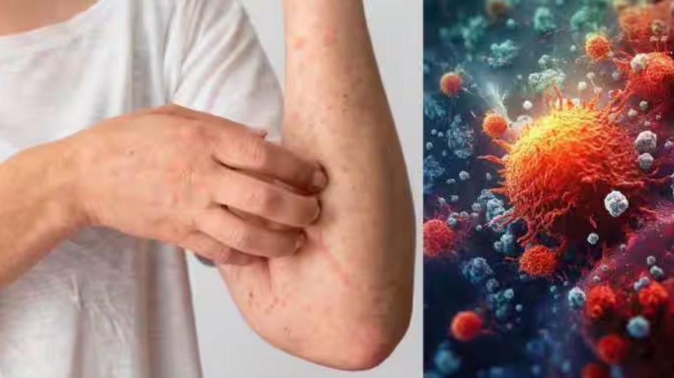 Mpox Case: രാജ്യത്ത് എംപോക്സ് ലക്ഷണങ്ങളോടെ ഒരാൾ ചികിത്സയിൽ; ആരോഗ്യനില തൃപ്തികരമെന്ന് കേന്ദ്ര ആരോഗ്യമന്ത്രാലയം Mpox Case: രാജ്യത്ത് എംപോക്സ് ലക്ഷണങ്ങളോടെ ഒരാൾ ചികിത്സയിൽ; ആരോഗ്യനില തൃപ്തികരമെന്ന് കേന്ദ്ര ആരോഗ്യമന്ത്രാലയം