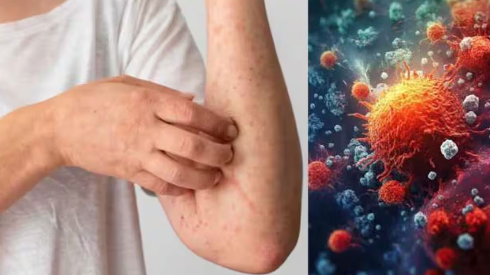 MPox in Malappuram: നിപയ്ക്ക് പിന്നാലെ മലപ്പുറത്ത് എംപോക്സും? യുവാവ് നിരീക്ഷണത്തിൽ! MPox in Malappuram: നിപയ്ക്ക് പിന്നാലെ മലപ്പുറത്ത് എംപോക്സും? യുവാവ് നിരീക്ഷണത്തിൽ!