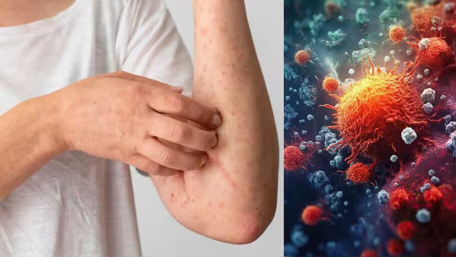 Mpox Kerala: കേരളത്തിൽ എംപോക്സ്; മലപ്പുറത്ത് എംപോക്സ് സ്ഥിരീകരിച്ചു, രോ​ഗി ചികിത്സയിൽ