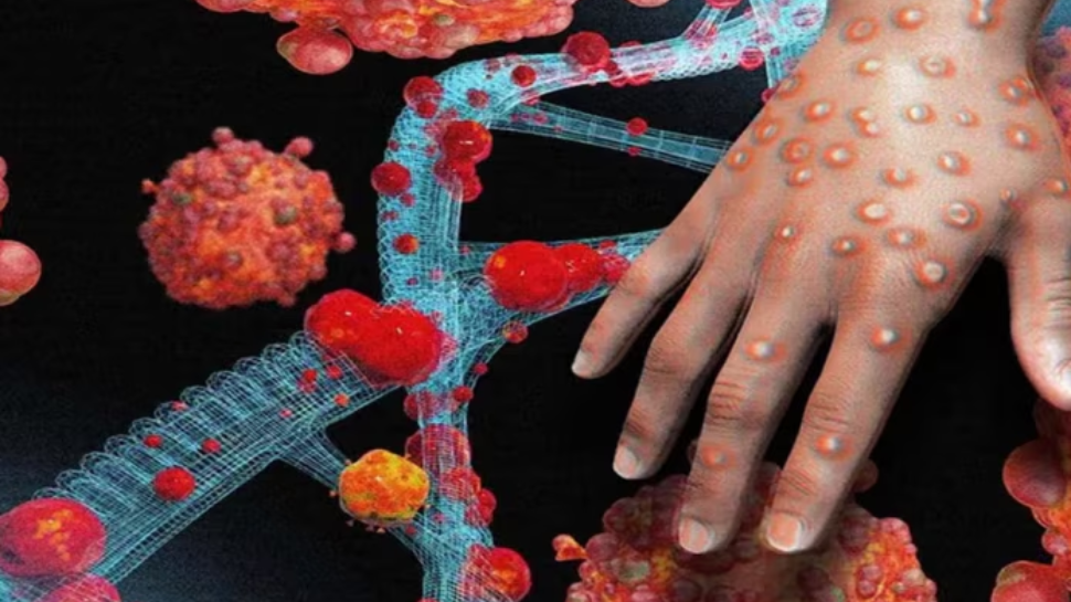 MPox: സംസ്ഥാനത്ത് വീണ്ടും എംപോക്സ്; രോഗം സ്ഥിരീകരിച്ചത് വിദേശത്ത് നിന്നെത്തിയ എറണാകുളം സ്വദേശിക്ക് MPox: സംസ്ഥാനത്ത് വീണ്ടും എംപോക്സ്; രോഗം സ്ഥിരീകരിച്ചത് വിദേശത്ത് നിന്നെത്തിയ എറണാകുളം സ്വദേശിക്ക്
