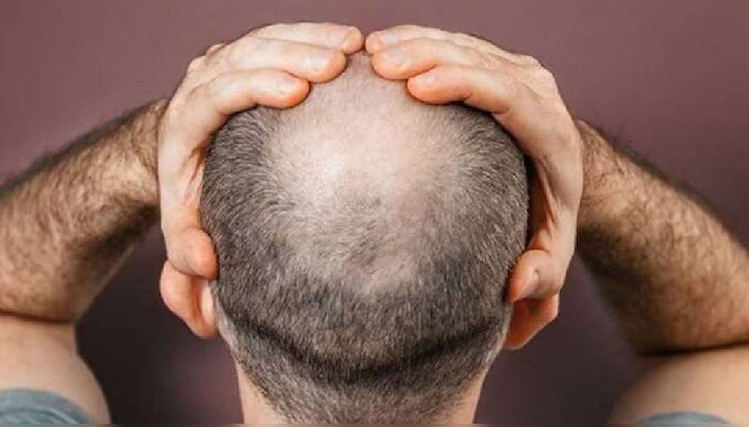 Hair loss in Maharashtra: അമിതമായി മുടികൊഴിഞ്ഞ് കഷണ്ടിയാകുന്നു; പരിഭ്രാന്തിയിലായി മഹാരാഷ്ട്രയിലെ ഗ്രാമം