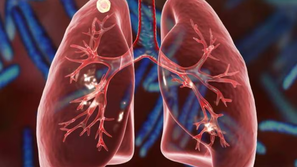 Tuberculosis: ക്ഷയരോഗത്തെ തുടച്ചു നീക്കാൻ ഒരുമിച്ചുള്ള പ്രവർത്തനം അനിവാര്യമെന്ന് ആരോഗ്യ മന്ത്രി വീണാ ജോർജ് Tuberculosis: ക്ഷയരോഗത്തെ തുടച്ചു നീക്കാൻ ഒരുമിച്ചുള്ള പ്രവർത്തനം അനിവാര്യമെന്ന് ആരോഗ്യ മന്ത്രി വീണാ ജോർജ്