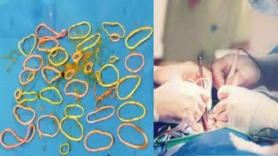Shocking News: നാല്പതുകാരിയുടെ വയറ്റിൽ 41 റബർ ബാൻഡുകൾ; സംഭവം തിരുവനന്തപുരത്ത് Shocking News: നാല്പതുകാരിയുടെ വയറ്റിൽ 41 റബർ ബാൻഡുകൾ; സംഭവം തിരുവനന്തപുരത്ത്
