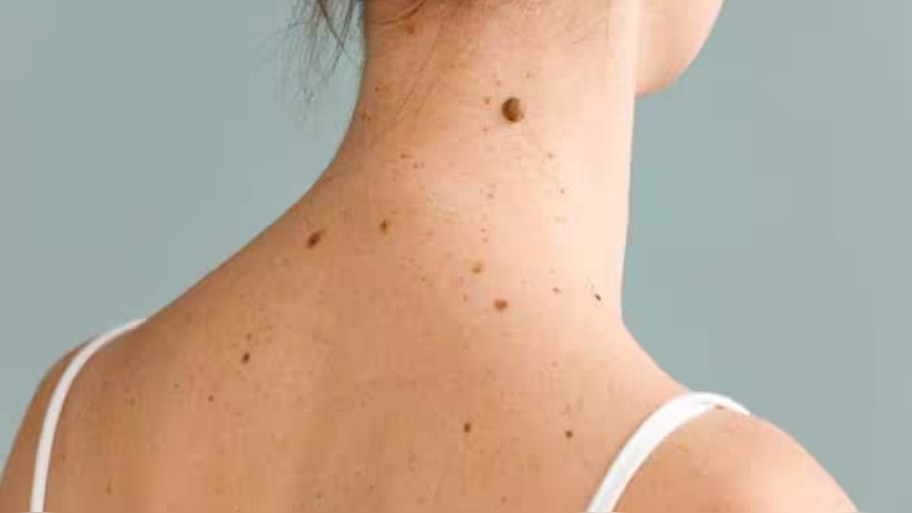  Moles On Skin:ചർമ്മത്തിലെ മറുകും പാലുണ്ണിയും കളയാൻ ബുദ്ധിമുട്ടുന്നുണ്ടോ? ഈ പ്രകൃതിദത്ത ചേരുവകൾ ഉപയോഗിക്കൂ