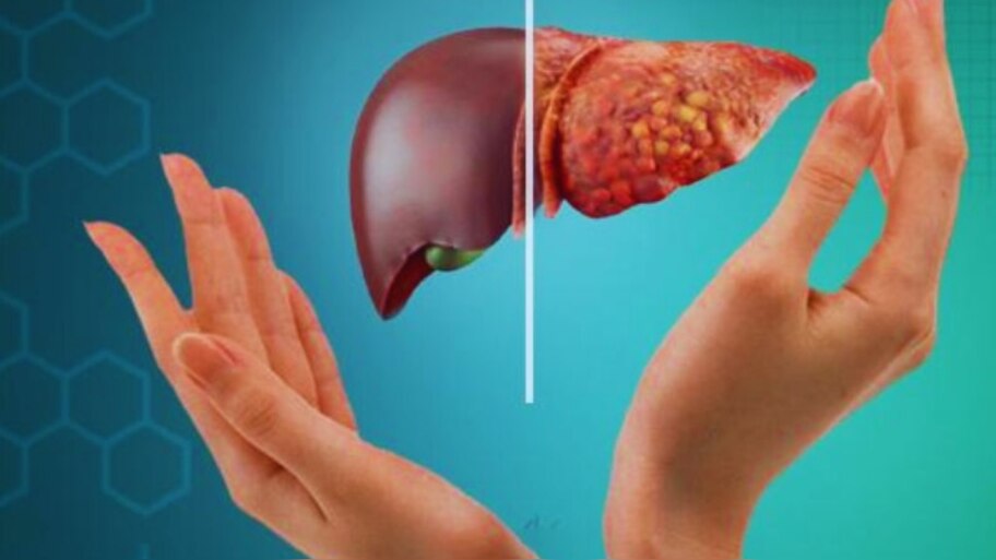Fatty Liver Symptoms: നിങ്ങൾക്ക് ഫാറ്റി ലിവറുണ്ടോ? തിരച്ചറിയാം ഈ ലക്ഷണങ്ങളിലൂടെ