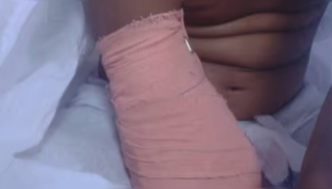 Palakkad News: ഒമ്പതുകാരിയുടെ കൈ മുറിച്ചു മാറ്റിയ സംഭവം; പാലക്കാട്ടെ ഡോക്ടർമാർക്ക് ക്ലീൻ ചിറ്റ് നൽകി അന്വേഷണ റിപ്പോർട്ട്