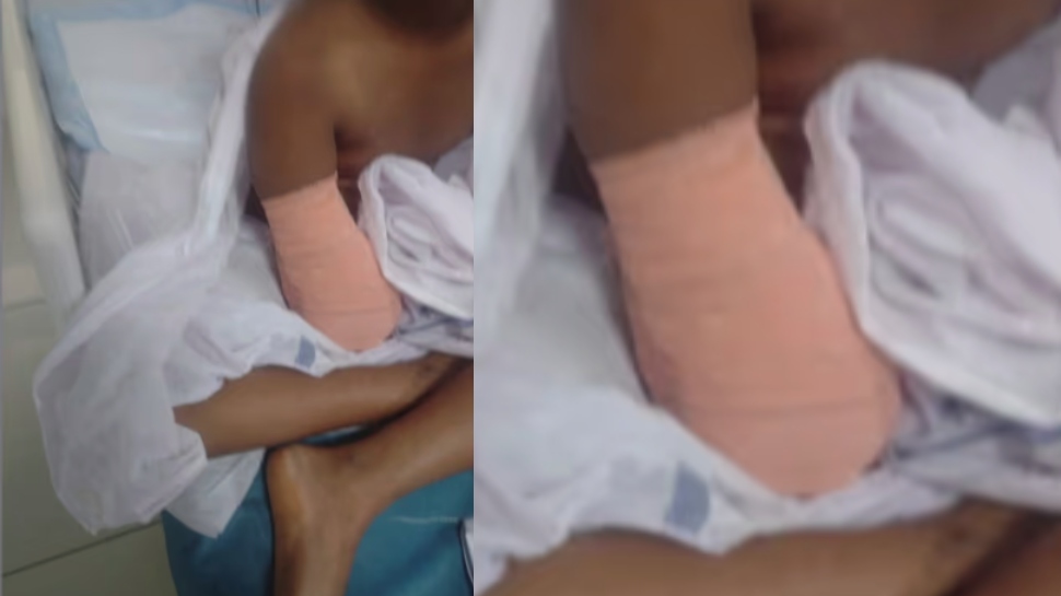 Child Hand Amputated: ഒൻപത് വയസുകാരിയുടെ കൈ മുറിച്ചുമാറ്റിയ സംഭവം; പാലക്കാട് ജില്ലാ ആശുപത്രിയിലെ രണ്ട് ഡോക്ടർമാരെ സസ്പെൻ്റ് ചെയ്തു Child Hand Amputated: ഒൻപത് വയസുകാരിയുടെ കൈ മുറിച്ചുമാറ്റിയ സംഭവം; പാലക്കാട് ജില്ലാ ആശുപത്രിയിലെ രണ്ട് ഡോക്ടർമാരെ സസ്പെൻ്റ് ചെയ്തു