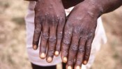 Monkeypox: യുകെയിൽ മങ്കി പോക്സ്; ലക്ഷണങ്ങളും ചികിത്സയും