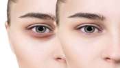 Dark Circles: കണ്ണിന് ചുറ്റുമുള്ള കറുപ്പ്  മാറ്റാം, ഈ അടുക്കള നുറുങ്ങുകള്‍ പരീക്ഷിക്കൂ 