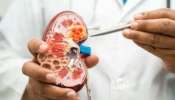 Worst Food For Kidney: ഈ ഭക്ഷണങ്ങള്‍ കിഡ്നിക്ക് ഹാനികരം, അബദ്ധത്തിൽ പോലും കഴിയ്ക്കുന്നത്‌ ഒഴിവാക്കാം 