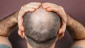 Hair loss in Maharashtra: അമിതമായി മുടികൊഴിഞ്ഞ് കഷണ്ടിയാകുന്നു; പരിഭ്രാന്തിയിലായി മഹാരാഷ്ട്രയിലെ ഗ്രാമം