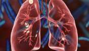 Tuberculosis: ക്ഷയരോഗത്തെ തുടച്ചു നീക്കാൻ ഒരുമിച്ചുള്ള പ്രവർത്തനം അനിവാര്യമെന്ന് ആരോഗ്യ മന്ത്രി വീണാ ജോർജ്