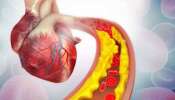 Cholesterol Symptoms:  ഉയര്‍ന്ന കൊളസ്‌ട്രോള്‍ ; ശ്രദ്ധിക്കാം ഈ രോഗലക്ഷണങ്ങള്‍