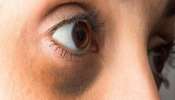 Dark Circles:  കണ്ണിന് ചുറ്റും ഡാര്‍ക്ക് സര്‍ക്കിളുണ്ടോ? എങ്കില്‍ ഇനി പാര്‍ലറില്‍ പോയി സമയം കളയേണ്ട! വീട്ടില്‍ പരീക്ഷിക്കാം ഈ ടിപ്‌സുകള്‍