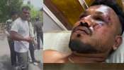 Ahmedabad Plane Crash: വിമാനാപകടത്തിലെ അത്ഭുത രക്ഷപ്പെടല്‍; ഒരാൾ ചികിത്സയിൽ