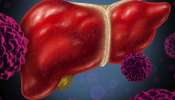 Liver Health: ശരീരം നൽകുന്ന ഈ സൂചനകൾ അവ​ഗണിക്കരുത്! കരളിന്റെ ആരോ​ഗ്യം അപകടത്തിലാകുന്നതിന്റെ ലക്ഷണങ്ങൾ