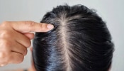 Oily Scalp Remedies: എണ്ണമയമുള്ള മുടിയാണോ പ്രശ്നം? പരിഹരിക്കാൻ പരീക്ഷിക്കാം ഈ സ്മാർട്ട് ടിപ്‌സുകൾ