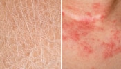 Dry Skin vs Eczema: ഒറ്റനോട്ടത്തിൽ ഒരുപോലെ, പക്ഷേ ഒന്നല്ല..! വരണ്ട ചർമ്മവും എക്സിമയും തമ്മിലുള്ള വ്യത്യാസങ്ങൾ...