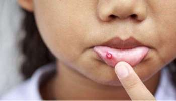 Mouth Ulcer: വായ്പുണ്ണ് ഭേദമാകാൻ ചില പൊടികൈകൾ 