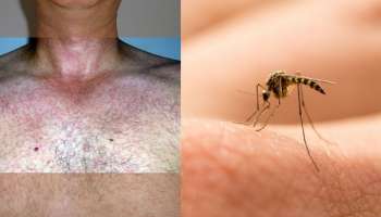 Zika Virus Kerala: വാക്സിനില്ലാത്ത സിക, കൊതുകിനെ സൂക്ഷിക്കുക, ഇതാണ് ലക്ഷണങ്ങൾ