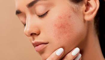 Winter Rash : മഞ്ഞ് കാലത്ത് ചർമ്മത്തെ സംരക്ഷിക്കാൻ ചില വിദ്യകൾ