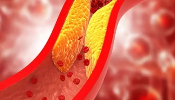 Signs of Cholestrol: കൊളസ്ട്രോൾ കൂടുന്നുണ്ടോ? ഈ ലക്ഷണങ്ങൾ അവ​ഗണിക്കരുത്
