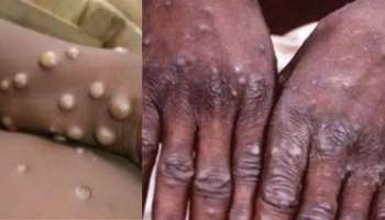 Monkeypox: കുരങ്ങ് പനി വ്യാപിക്കുന്നു; യുകെയിൽ മൂന്നാഴ്ച ക്വാറന്റൈൻ