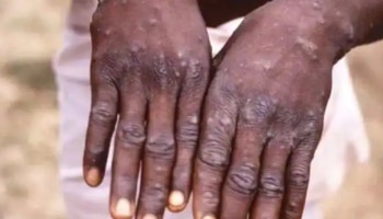 Monkeypox: കുരങ്ങ് പനി, രോ​ഗലക്ഷണങ്ങളുള്ളവരെ ഐസൊലേറ്റ് ചെയ്യാൻ സംസ്ഥാനങ്ങൾക്ക് നിർദേശം