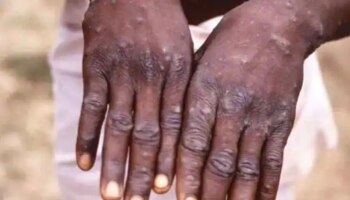 Monkeypox: കുരങ്ങ് പനി, രോ​ഗലക്ഷണങ്ങളുള്ളവരെ ഐസൊലേറ്റ് ചെയ്യാൻ സംസ്ഥാനങ്ങൾക്ക് നിർദേശം