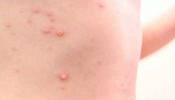 Monkeypox : വാനര വസൂരി കുട്ടികൾക്ക് ബാധിക്കാൻ സാധ്യത കൂടുതൽ; ജാഗ്രത പാലിക്കണമെന്ന് ഐസിഎംആർ