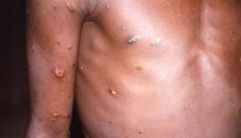 Monkey Pox : യുകെയിൽ 50 പേർക്ക് കൂടി വാനര വസൂരി സ്ഥിരീകരിച്ചു; ആശങ്ക വർധിക്കുന്നു 