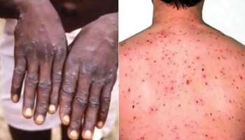 Monkey Pox Mutation: വാനര വസൂരി വൈറസിന് പ്രതീക്ഷിച്ചതിൽ കൂടുതൽ ജനിതക വകഭേദങ്ങളെന്ന് പഠനം