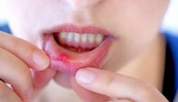 Mouth Ulcer Remedys:വായിലെ മുറിവ് ക്യാൻസറാകില്ല; പക്ഷെ മറ്റൊരു വലിയ പ്രശ്നമുണ്ട്