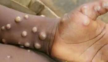 Monkeypox in India update: കൊൽക്കത്തയിൽ മങ്കിപോക്സ് ബാധിച്ചതായി സംശയിച്ചയാളുടെ പരിശോധനാ ഫലം പുറത്ത് വിട്ടു